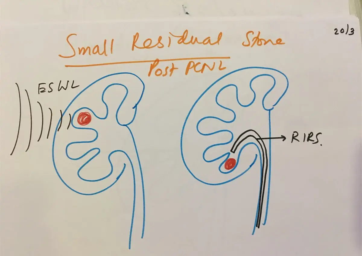 Two hand-drawn kidneys, one being treated with shock waves labelled ESWL and one with a flexible scope from below labelled RIRS, under the heading small residual stone post PCNL.