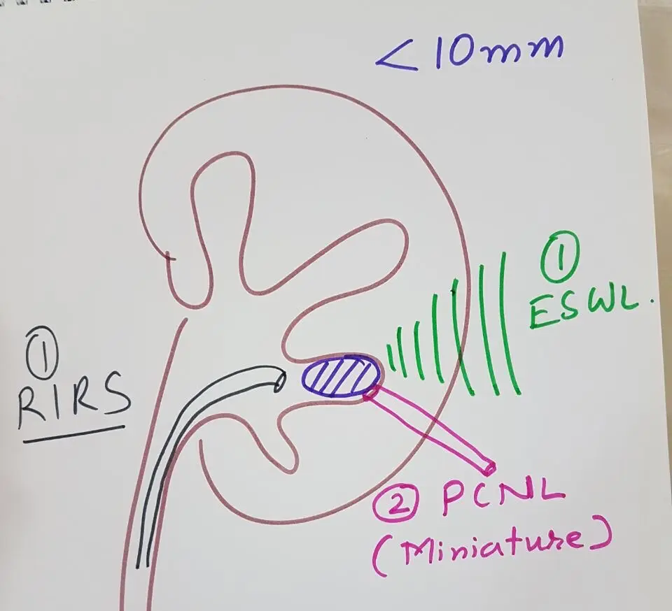 Hand-drawn kidney with a small stone, RIRS and ESWL marked as first options and miniature PCNL as second.