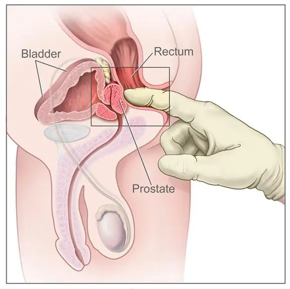 Side-view drawing of a gloved finger in the rectum, feeling the prostate through the rectal wall just below the bladder.
