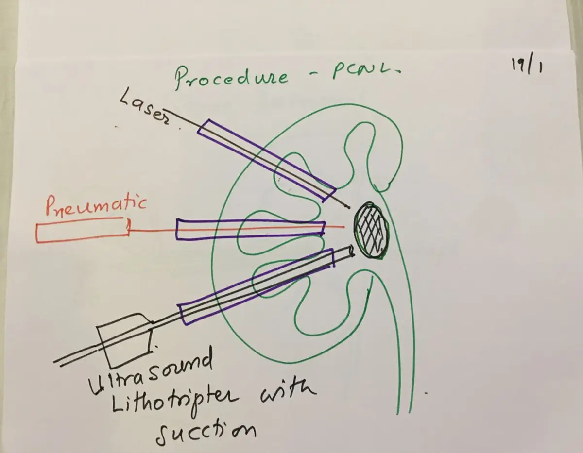 Hand-drawn diagram of a kidney with a stone being approached by a laser, a pneumatic probe and an ultrasound lithotripter with suction.