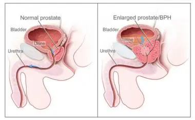 Side-by-side drawing of a normal prostate and an enlarged prostate, showing the enlarged gland narrowing the urethra below the bladder.