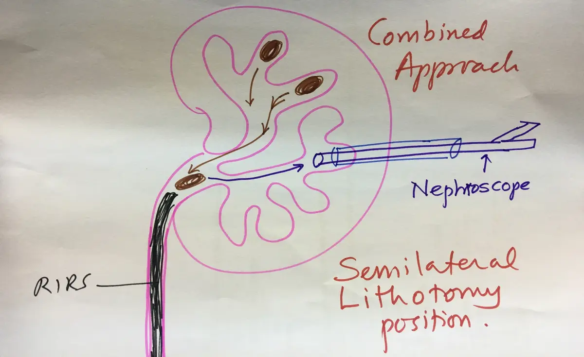 Hand-drawn kidney showing a flexible scope from below moving stones into the pelvis of the kidney, and a nephroscope through the back retrieving them.