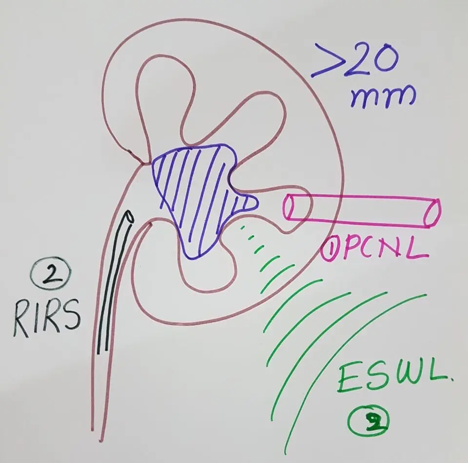 Hand-drawn kidney with a large stone, labelled first PCNL, second RIRS, third ESWL, for stones over 20 mm.